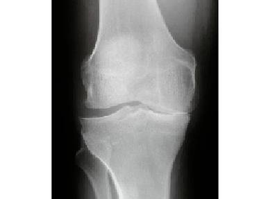 Diagnostika artrózy kolenného kĺbu