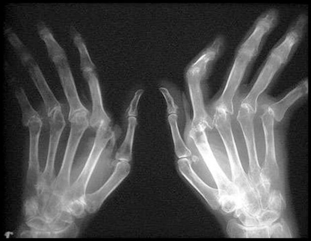 X -ray Obrázok rúk ovplyvnených artrózou