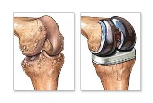 náhrada kolena pri artróze