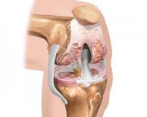 počiatočné štádium artrózy kolena