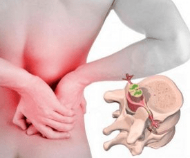 Lumbago na začiatku osteochondrózy choroby