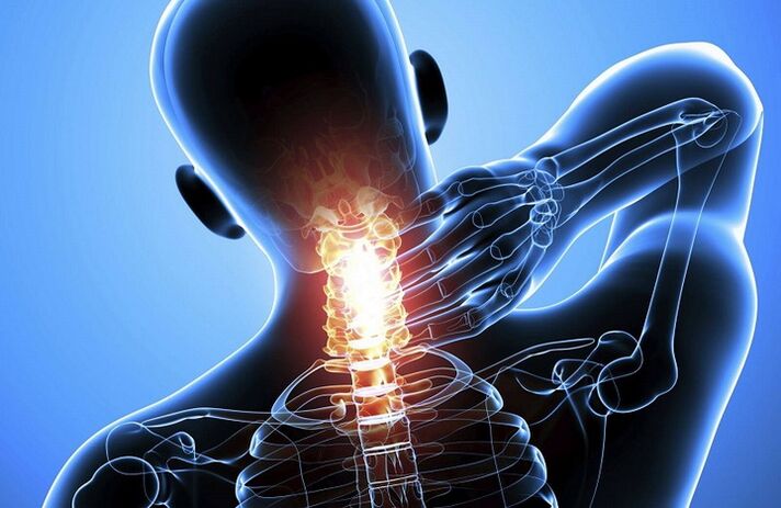 Cervikálna osteochondróza