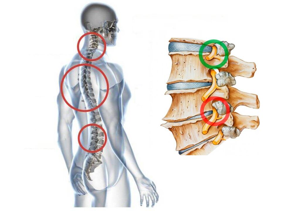 Ako vyzerá krčná osteochondróza stavcov
