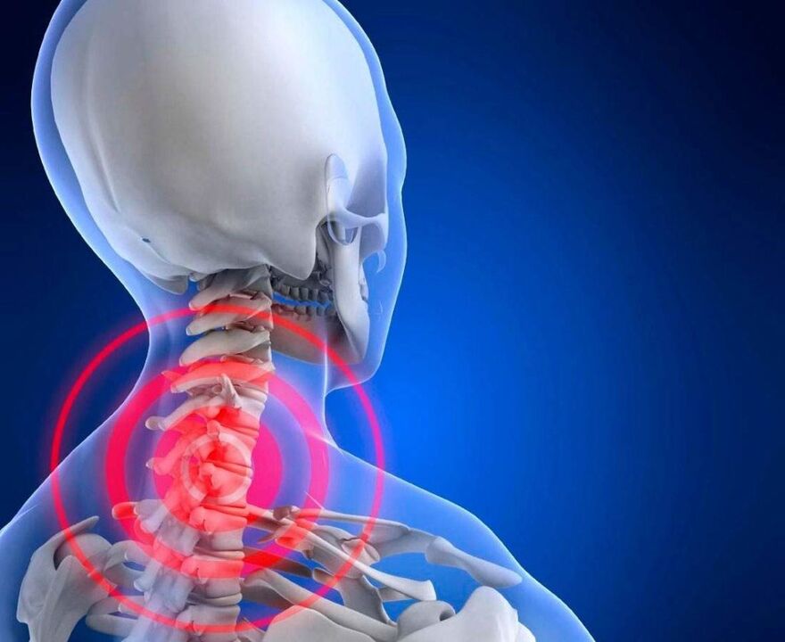 bolesť krku s cervikálnou osteochondrózou