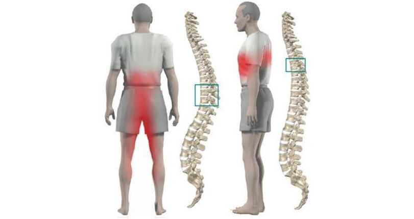 bolesť v tele a chrbtici s osteochondrózou