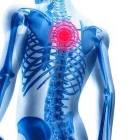 bolesť chrbta pri hrudnej osteochondróze