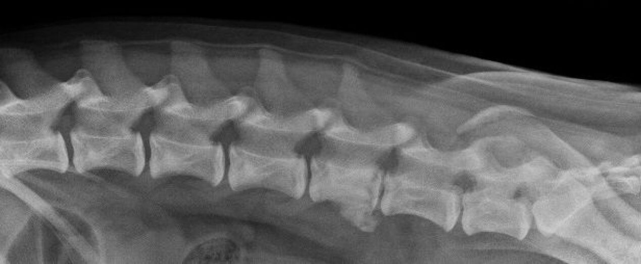 Prejavy osteochondrózy hrudnej chrbtice na röntgenovom snímku