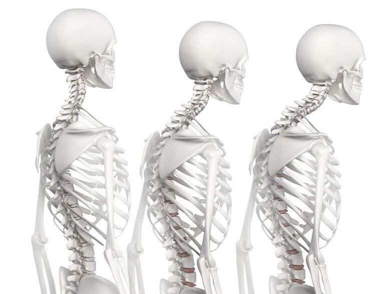 Stupne vývoja hrudnej osteochondrózy na príklade kostrového modelu