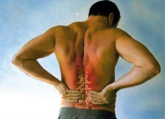 Bolesť bedrovej osteochondrózy