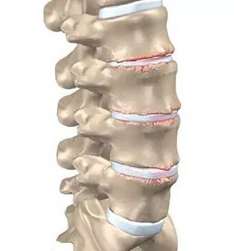 Osteochondróza